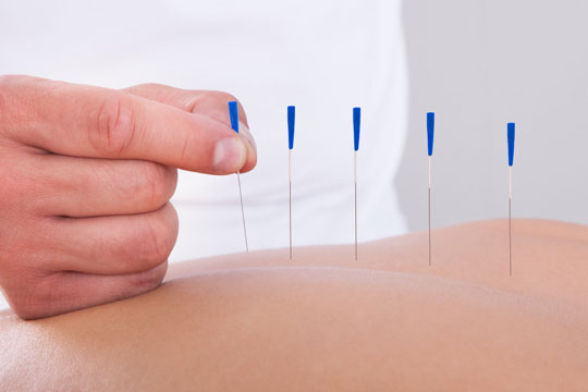 Acupuncture 